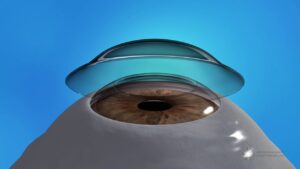 What Is Photorefractive Keratectomy (PRK)?